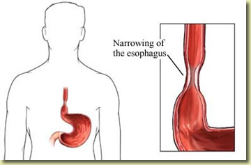 esophageal varices ted says how to treat